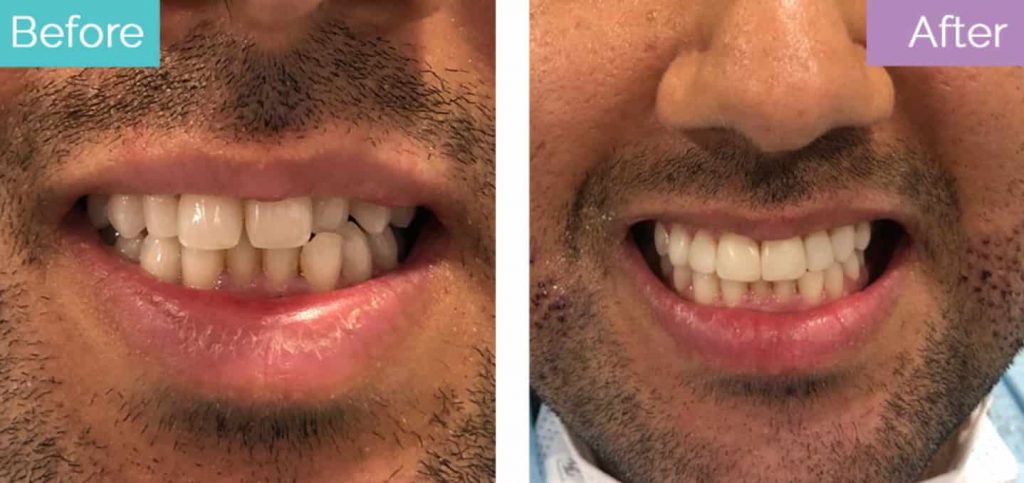 Composite bonding result