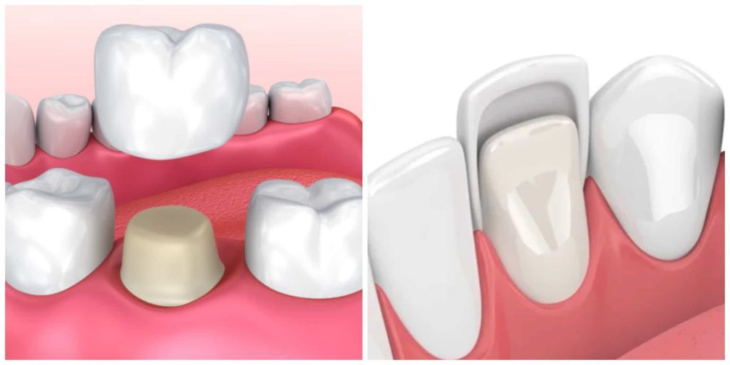 Crowns vs veneers