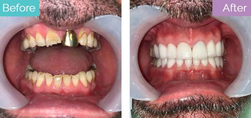 Dental crown results