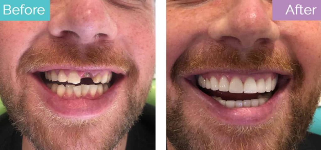 Dental crowns in Turkey