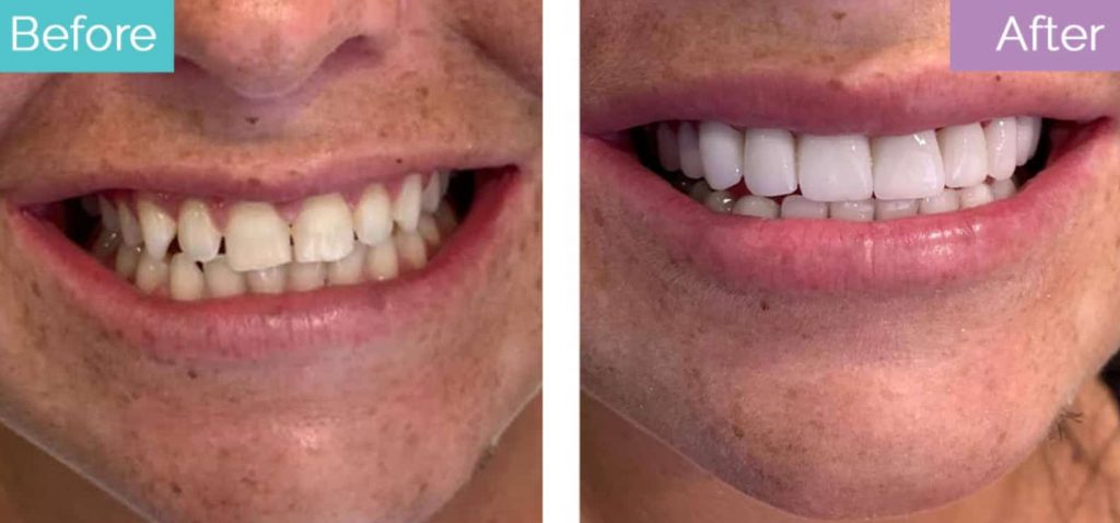 Dental veneers in turkey