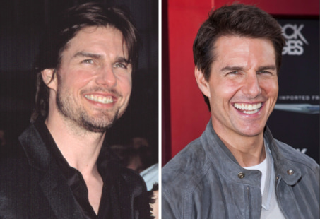Tom Cruise's teeth before and after