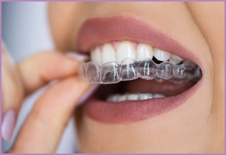 occlusal Splint