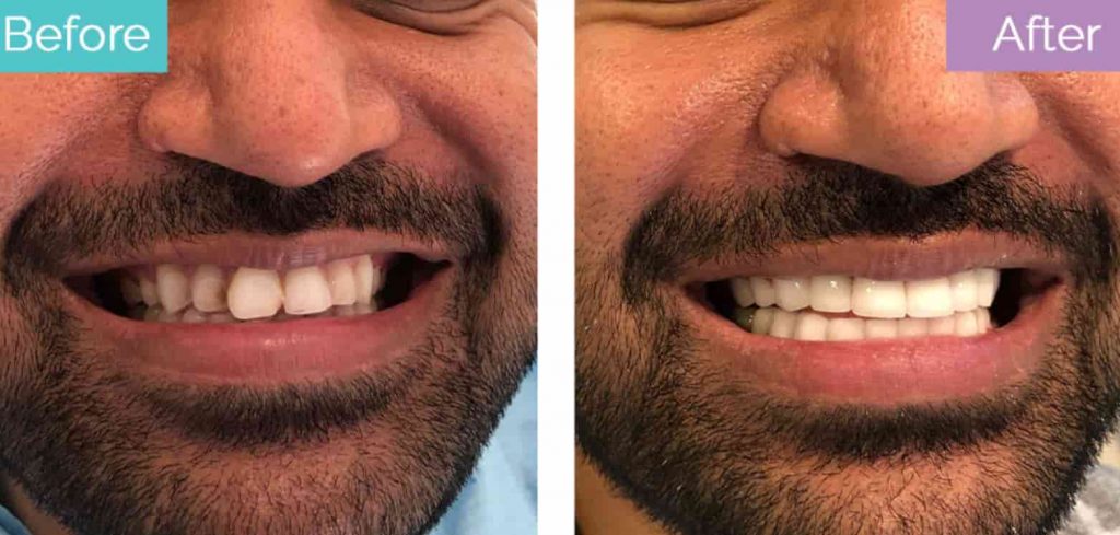 Buck teeth dental crowns