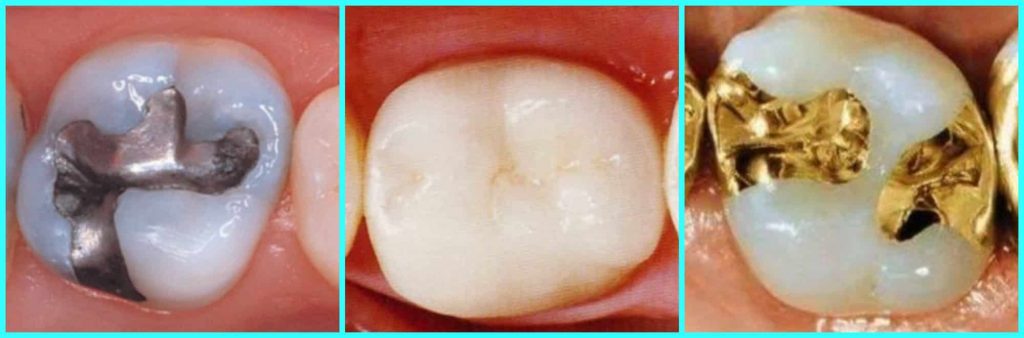 Tooth filling materials