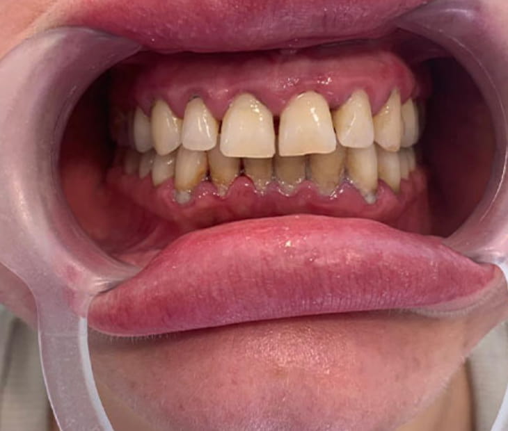 dental plaque