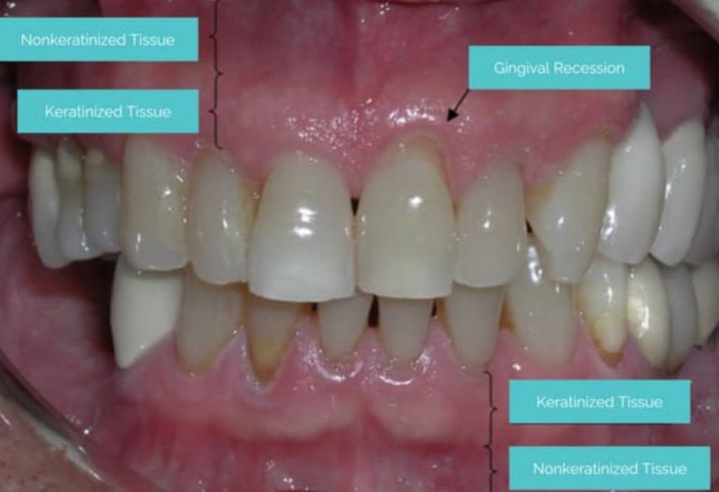 gum recession