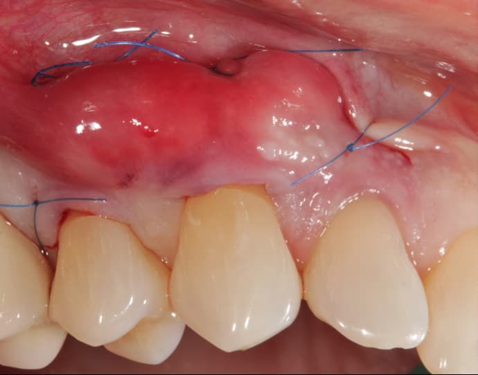 gum surgery
