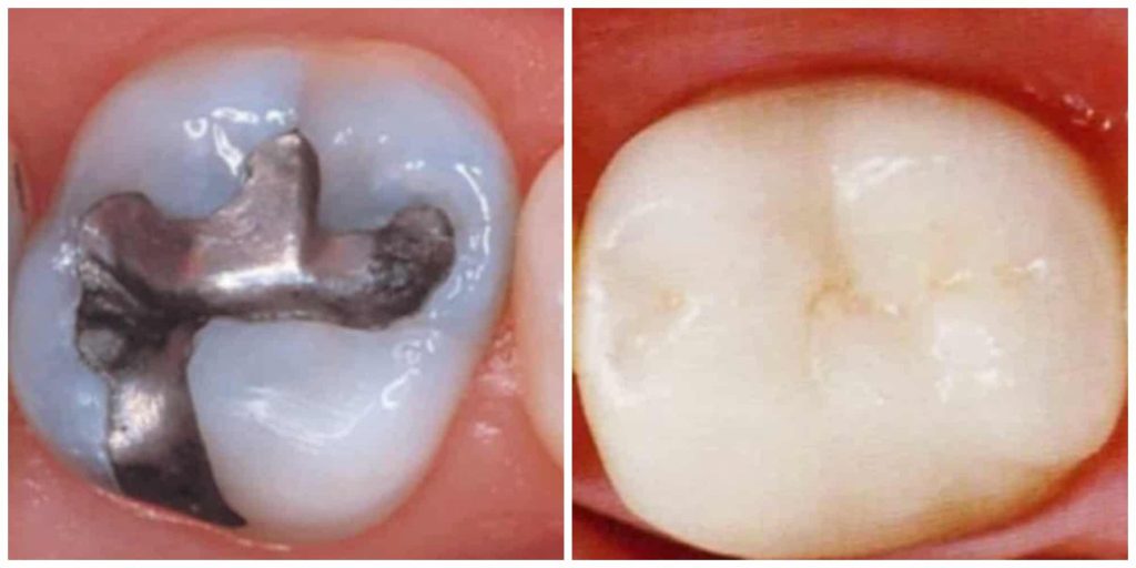 silver vs resin filling