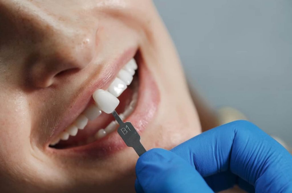 Veneers