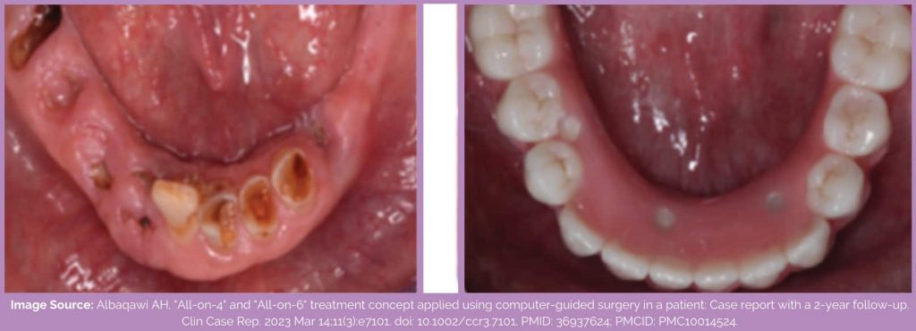 All on 4 implants before and after