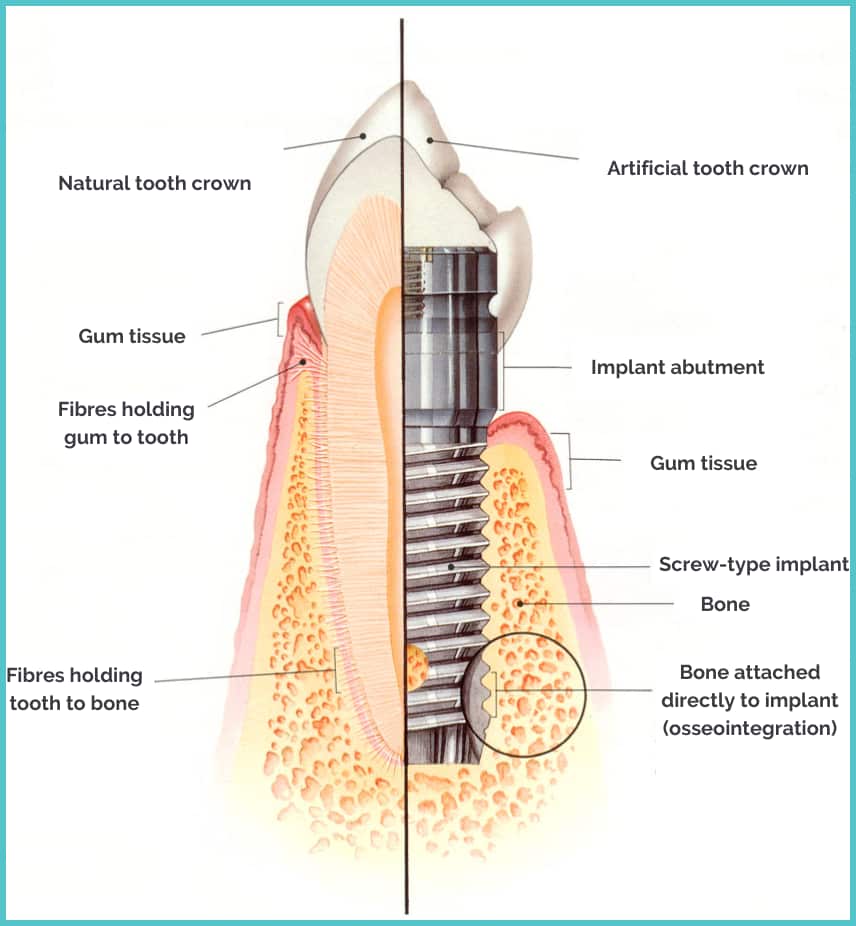 Osseointegration