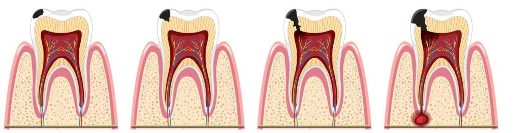 Decaying tooth