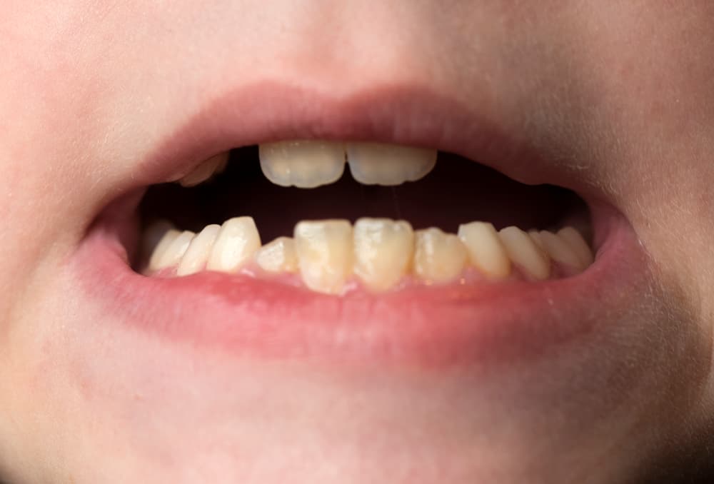 Jagged teeth