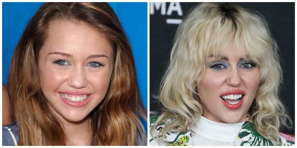 Miley Cyrus teeth before and after