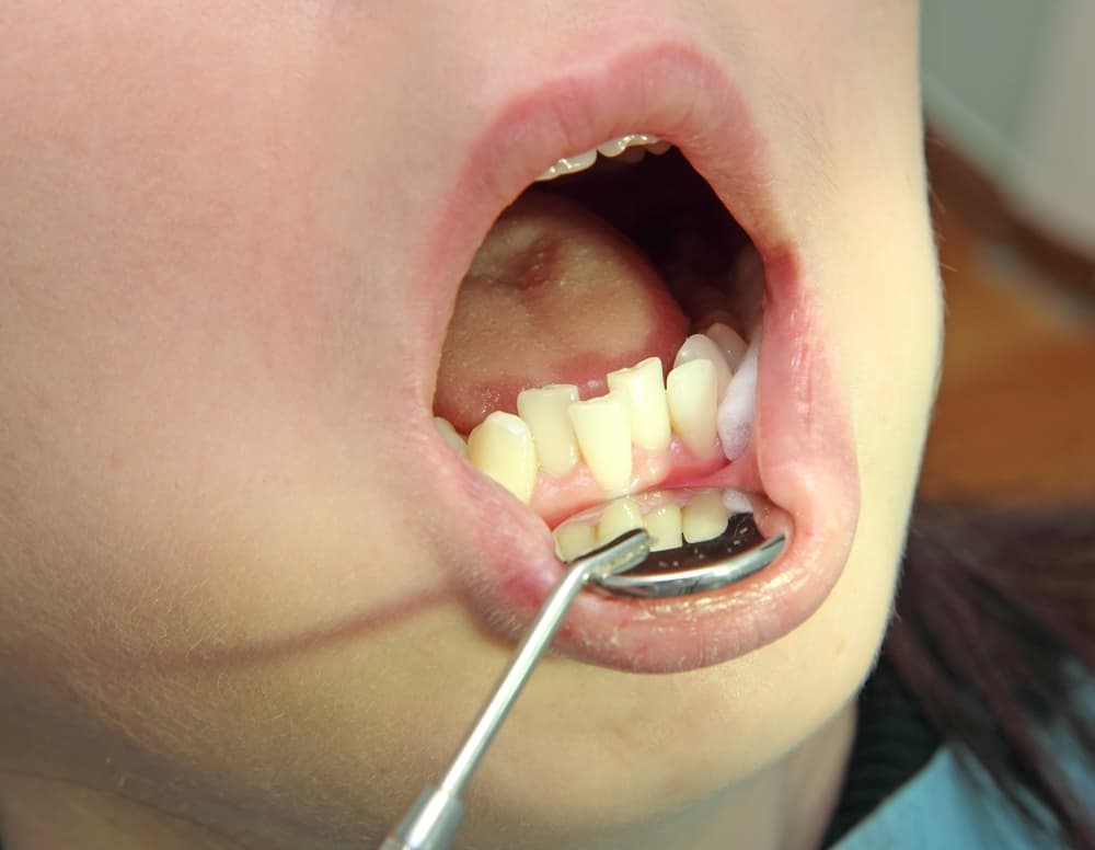 uneven teeth