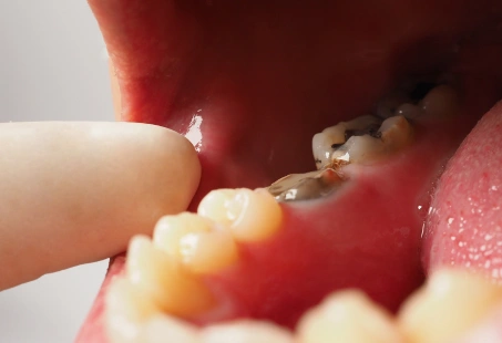 How To Treat Tooth Decay