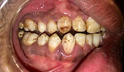 Dental fluorosis