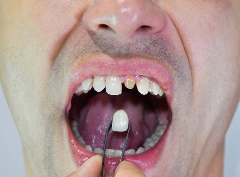 Dental restoration
