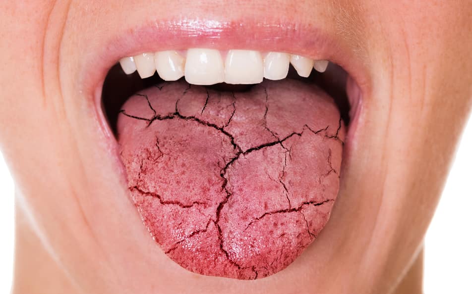 Dry tongue