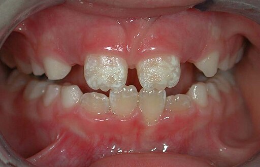 Enamel hypoplasia