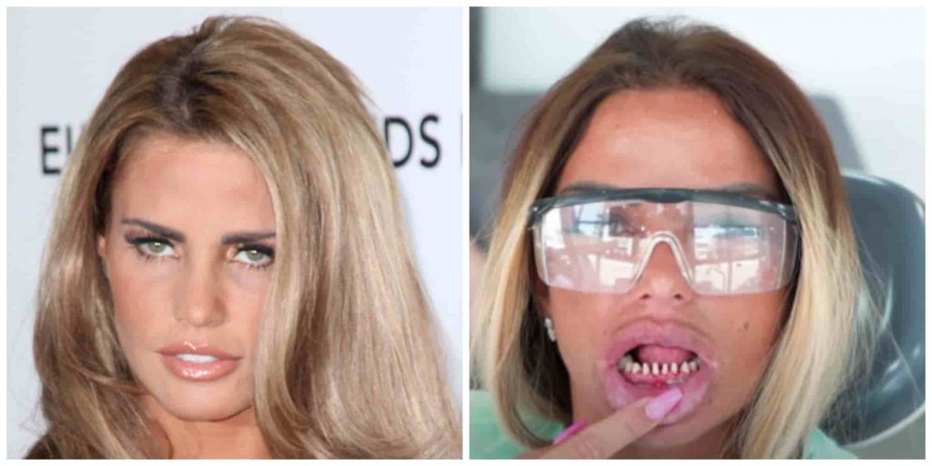 Katie Prices teeth