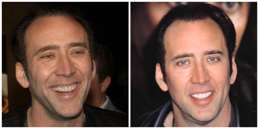 Nicolas cage fake teeth