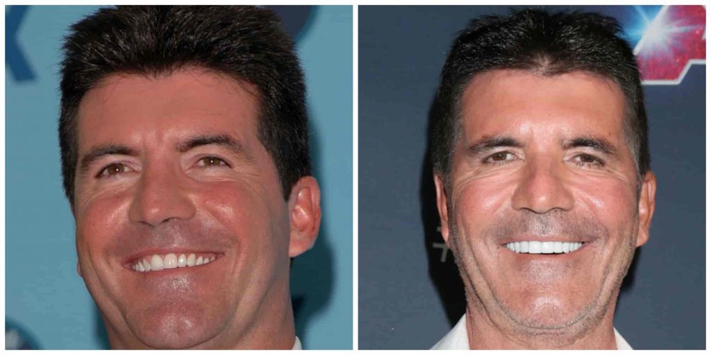 Simon Cowells teeth before and after