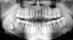 Tooth cyst