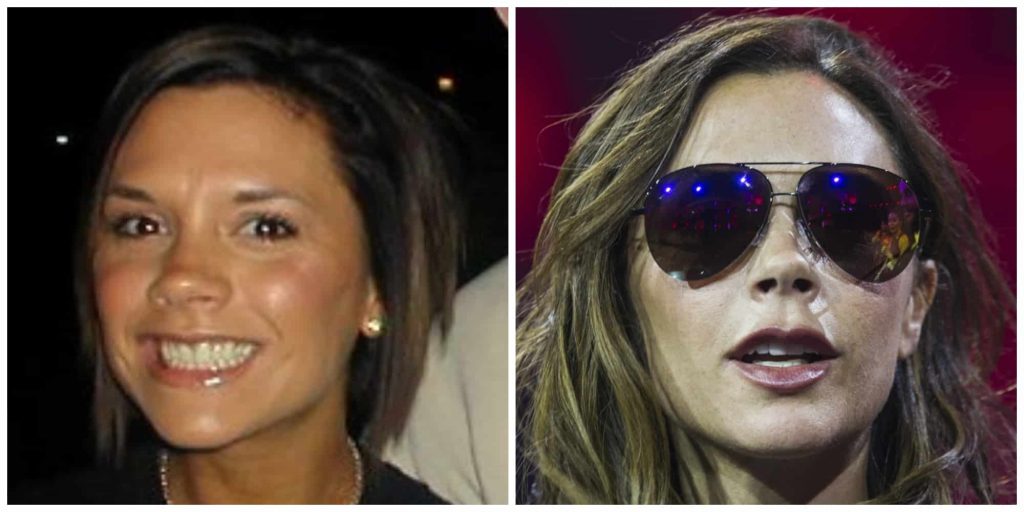 Victoria Beckhams teeth before and after