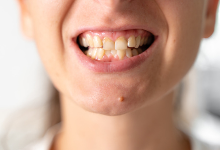 yellow spots on teeth