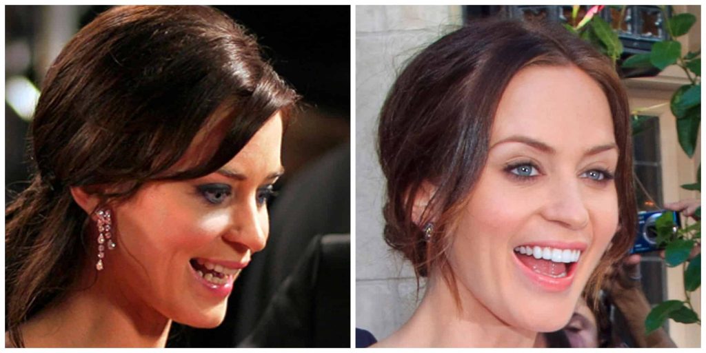 Emily Blunts teeth colour before and after