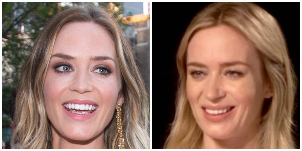 Emily blunt gum tissue