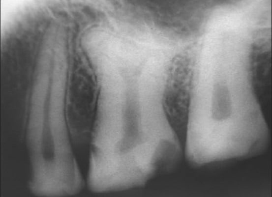 Taurodontism