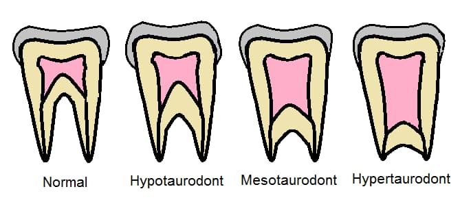 taurodontism types