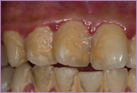 dental plaque
