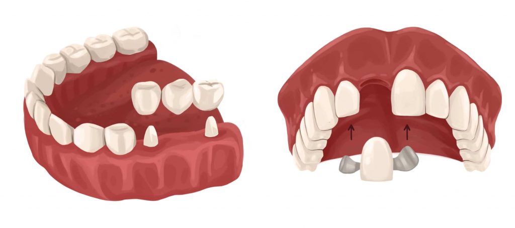 Maryland dental bridge vs traditional bridge