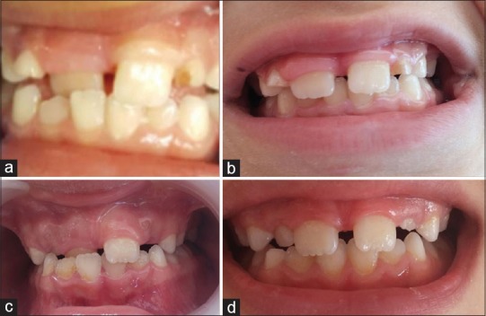 Crossbite