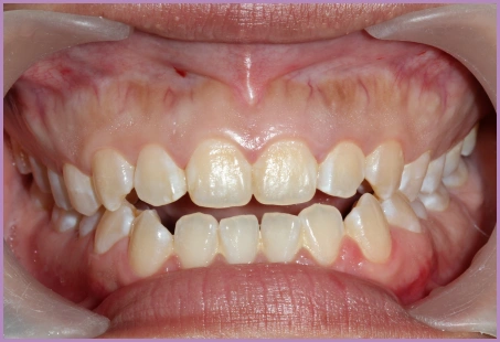 Open Bite