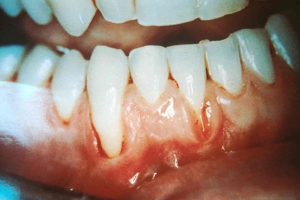 damaged gum