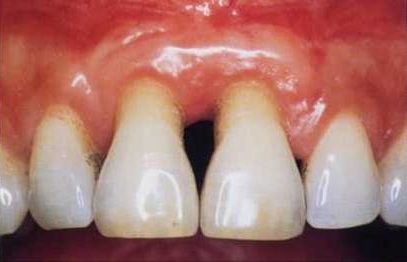 gum recession