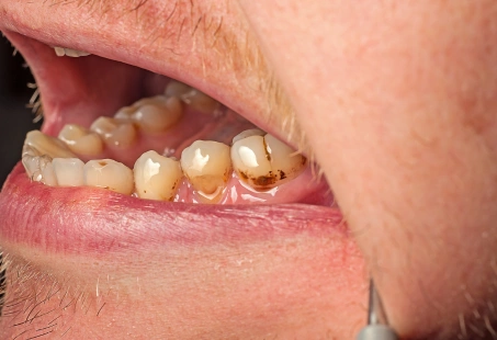 Brown spots plaque teeth