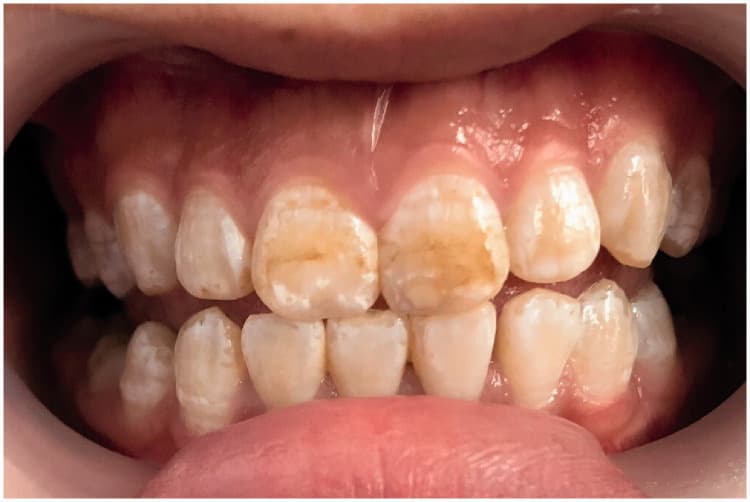 brown spots on teeth from fluorosis