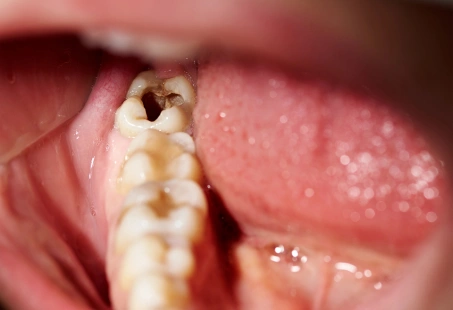 cavity