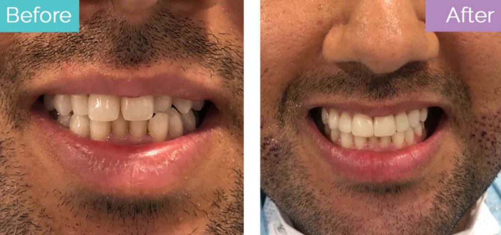 composite bonding result