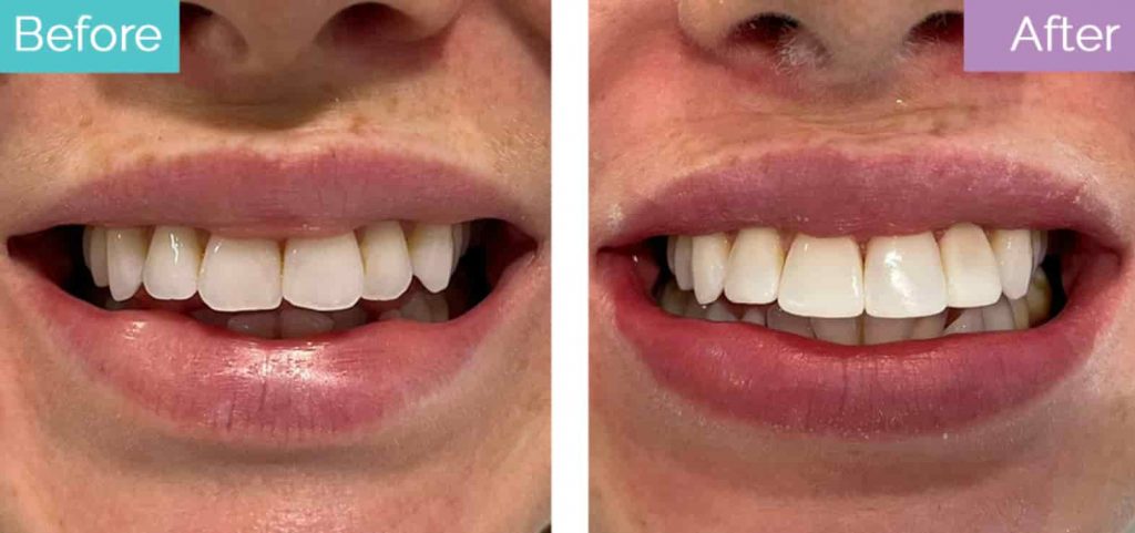 composite bonding smile makeover