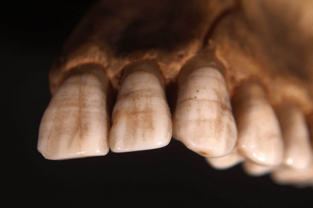 enamel hypoplasia