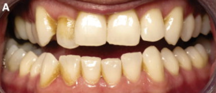 smoking stains on teeth