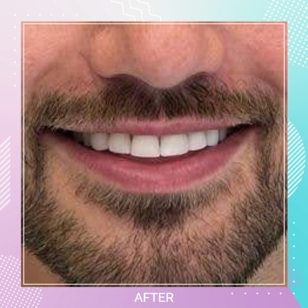 Composite Bonding patient 3 A 1