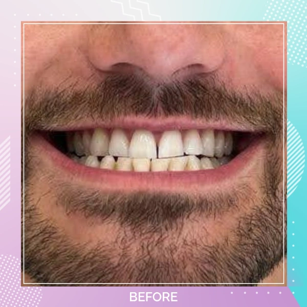 Composite Bonding patient 3 B 1